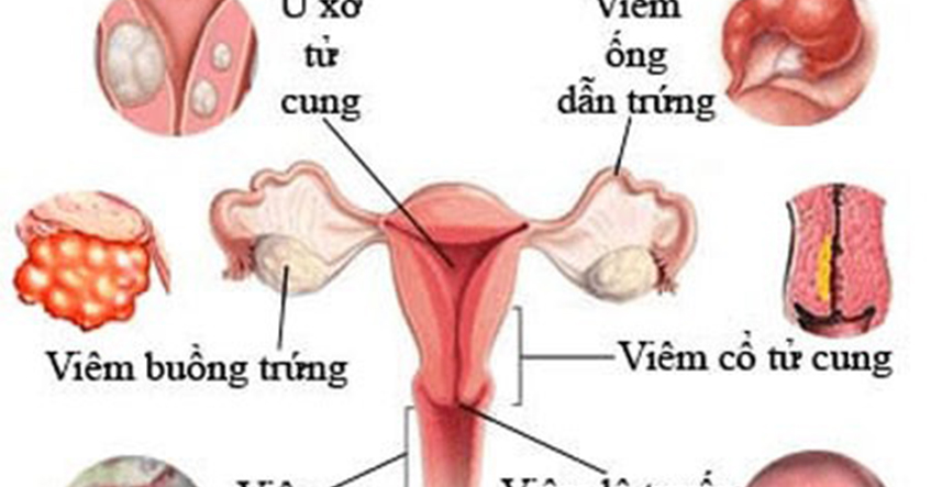 NHỮNG BỆNH PHỤ KHOA THƯỜNG GẶP
