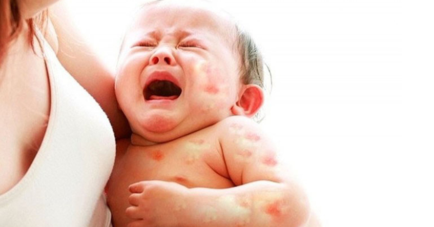 TRẺ BỊ DỊ ỨNG SỮA