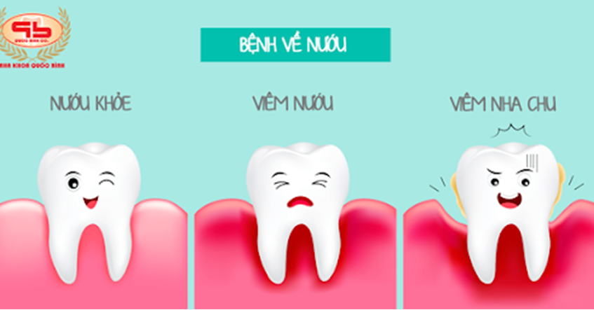 NHẬN BIẾT – PHÒNG NGỪA VIÊM NỨU RĂNG