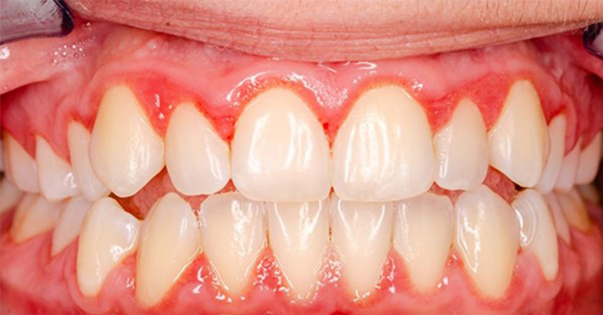 TẨY TRẮNG RĂNG VÀ NHỮNG ĐIỀU CẦN BIẾT