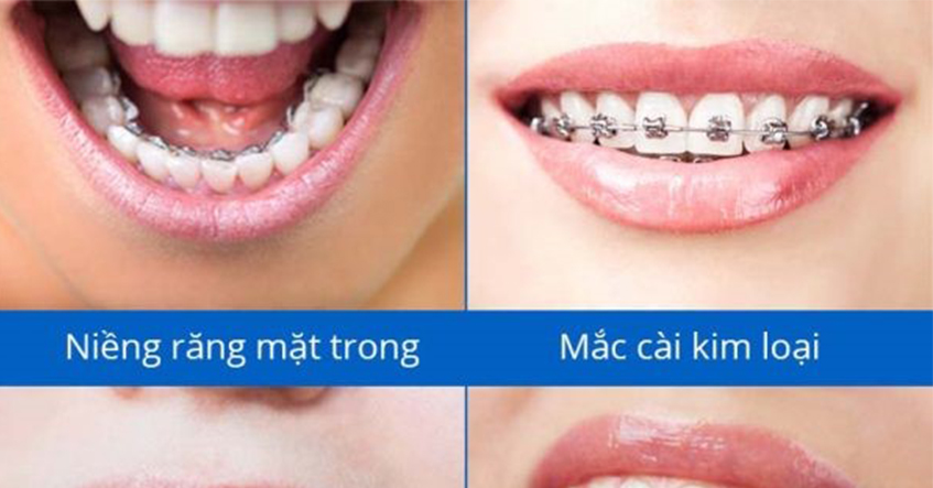 DẤU HIỆU VÀ THỜI ĐIỂM NÊN NIỀNG RĂNG