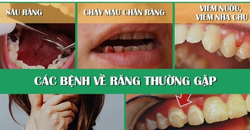NHỮNG BỆNH RĂNG MIỆNG THƯỜNG GẶP